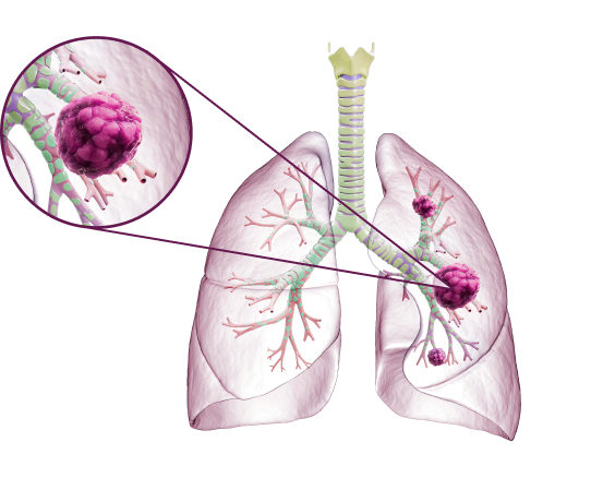 Атезолизумаб в сочетании с карбоплатином и этопозидом