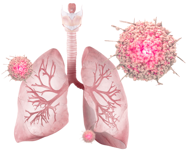 Монотерапия Атезолизумабом одобрена FDA